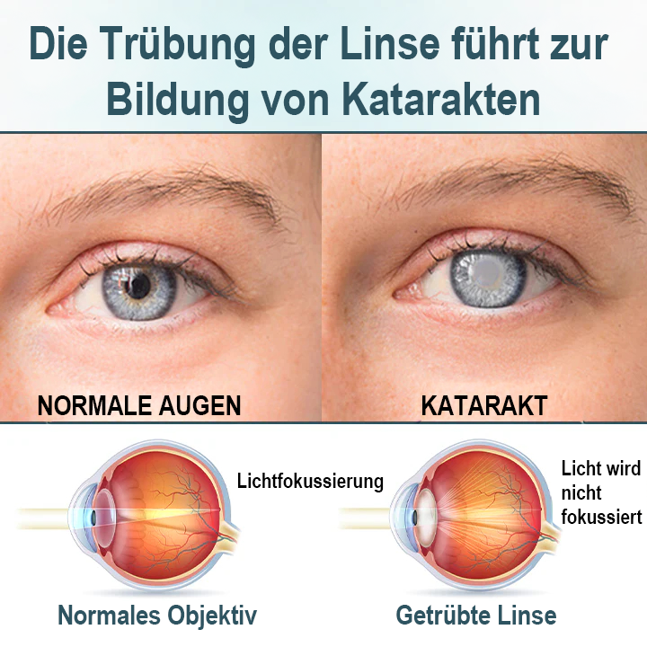 Spzv® OPTIFUSION NANO AUGENTROPFENSER 🧬 Nanotechnologie stellt klares Sehen wieder her, ohne Brille, ohne Operation