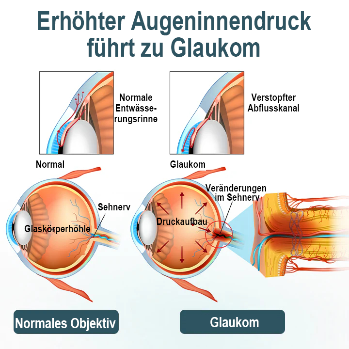 Spzv® OPTIFUSION NANO AUGENTROPFENSER 🧬 Nanotechnologie stellt klares Sehen wieder her,  ohne Brille, ohne Operation